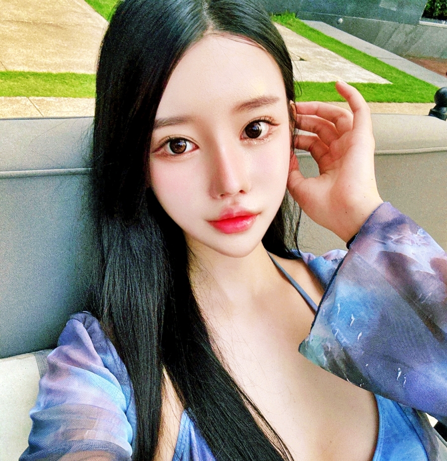 이중턱지방흡입 이미지 (4)