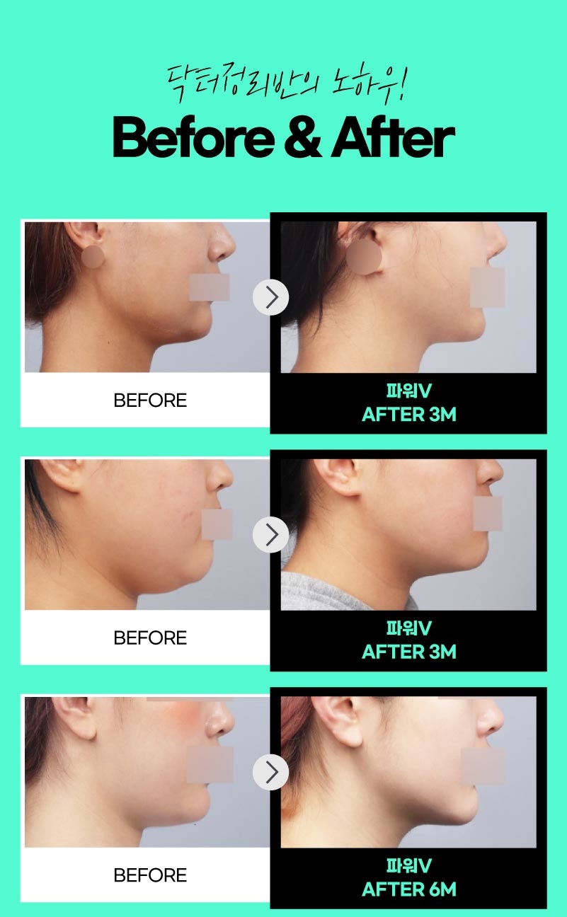 얼굴지방흡입 게시판 이미지 (15)