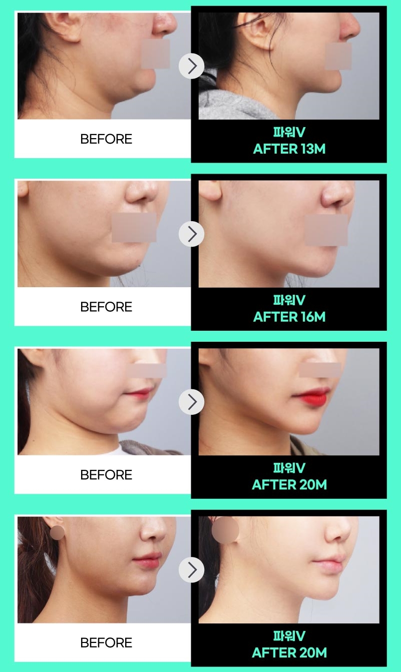 얼굴지방흡입 게시판 이미지 (16)