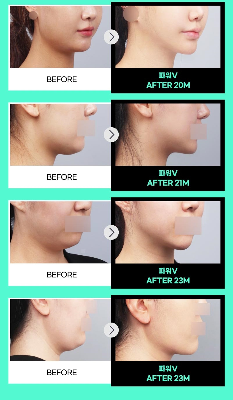 얼굴지방흡입 게시판 이미지 (17)