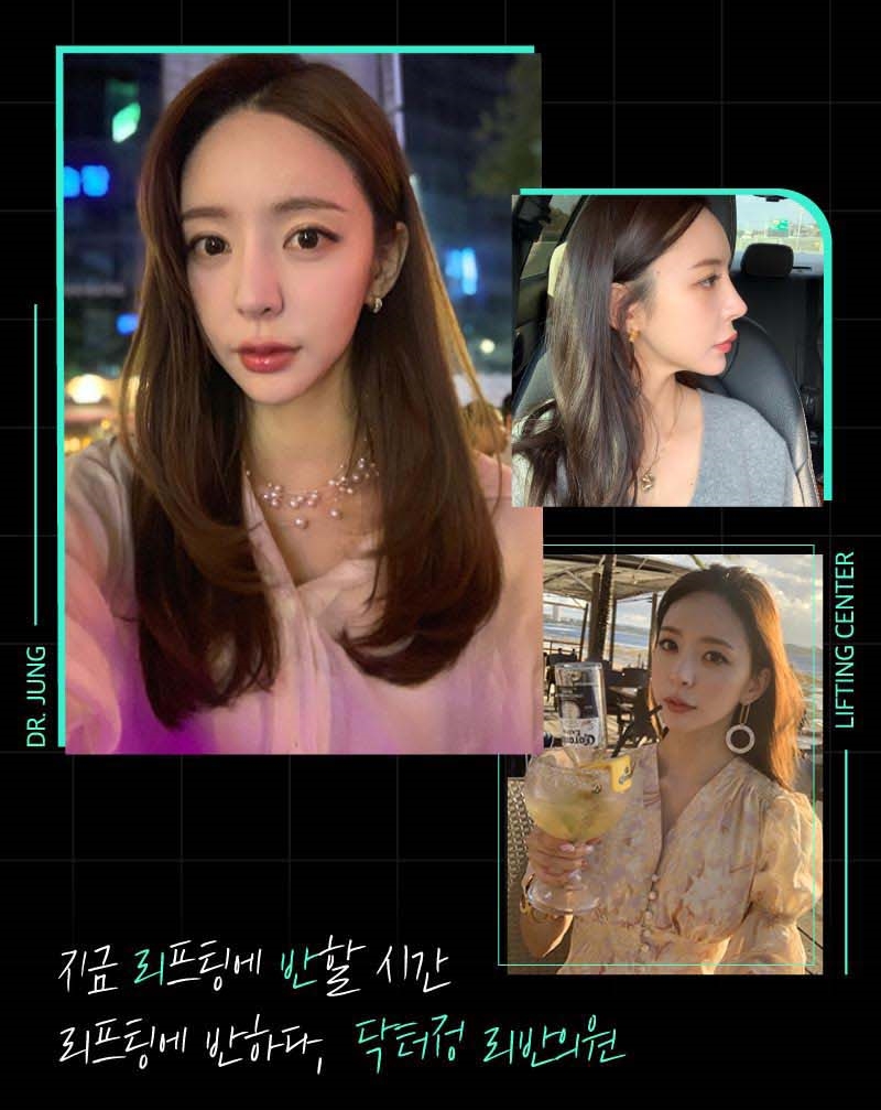 얼굴지방흡입 게시판 이미지 (4)